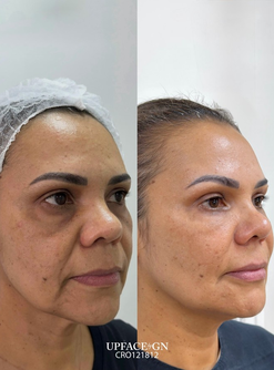 Antes e Depois Toxina Botulínica e Preenchimento