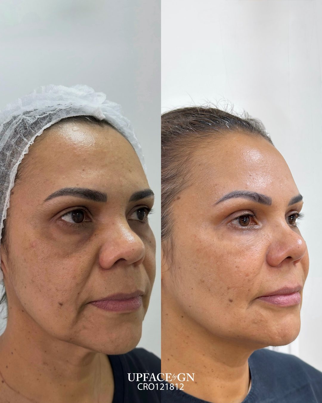 Antes e Depois Harmonização Facial Dra. Gisele Neves